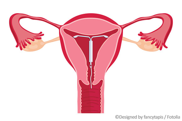 Einlage der T-Spirale in der Gebärmutter.