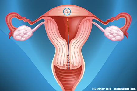 Abbildung einer illustrierten Gebärmutter mit GyneFix Kupferkette in der Gebärmutterdecke
